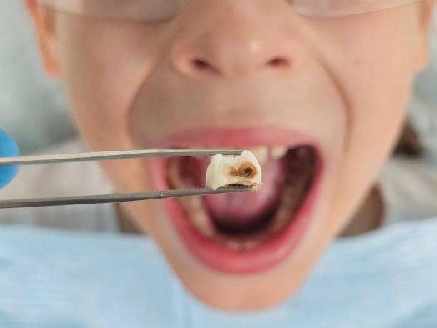 Best Emergency Dental Extractions in North Aurora, IL